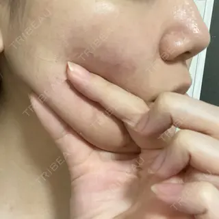 1日目の経過画像（2枚目）