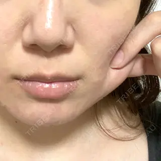 1日目の経過画像（3枚目）