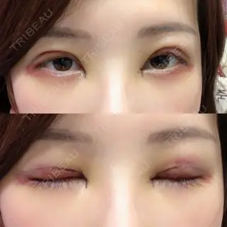 1日目の経過画像（1枚目）