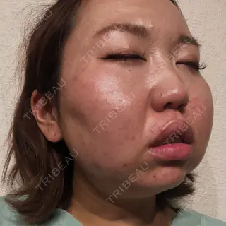 0日目の経過画像（2枚目）