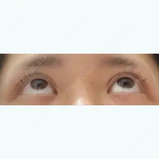 5日目の経過画像（3枚目）