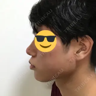 0日目の経過画像（2枚目）
