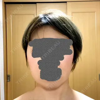 29日目の経過画像（1枚目）