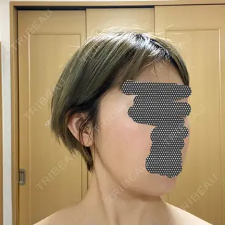 29日目の経過画像（3枚目）