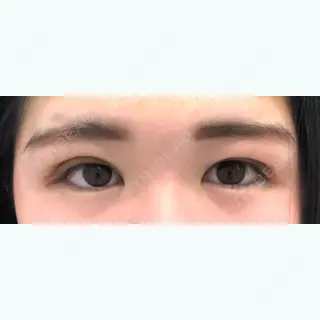 0日目の経過画像（1枚目）