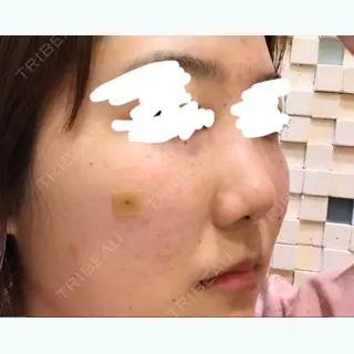 0日目の経過画像（3枚目）