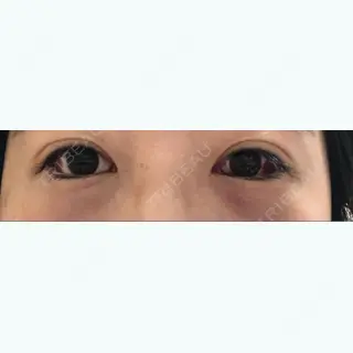 1日目の経過画像（1枚目）