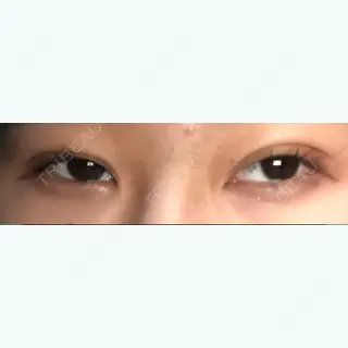 4日目の経過画像（1枚目）