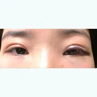 1日目の経過画像（1枚目）