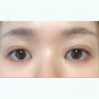 28日目の経過画像（2枚目）