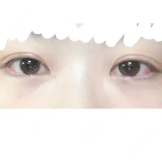 34日目の経過画像（2枚目）