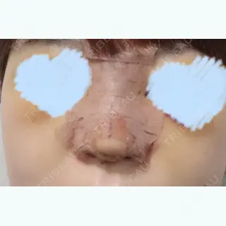 5日目の経過画像（1枚目）