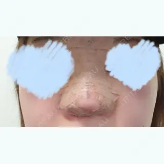 1日目の経過画像（1枚目）