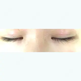 4日目の経過画像（3枚目）
