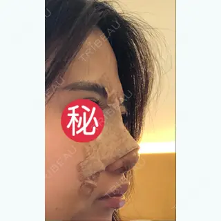 4日目の経過画像（2枚目）