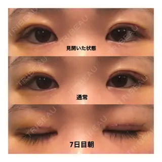 7日目の経過画像（1枚目）