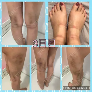 3日目の経過画像（3枚目）