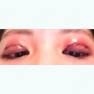0日目の経過画像（2枚目）