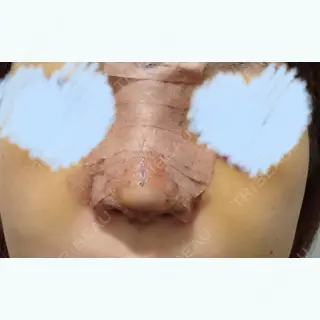 6日目の経過画像（1枚目）