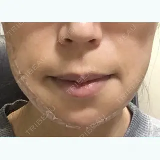 2日目の経過画像（3枚目）