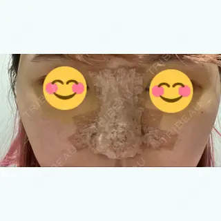 5日目の経過画像（1枚目）