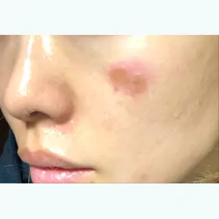0日目の経過画像（2枚目）