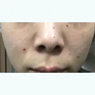 2日目の経過画像（1枚目）