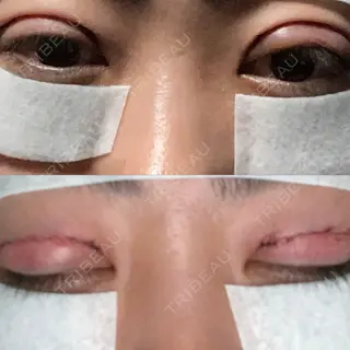 0日目の経過画像（2枚目）