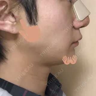 4日目の経過画像（2枚目）