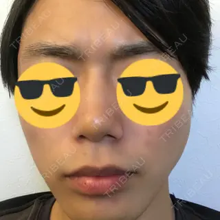 4日目の経過画像（1枚目）