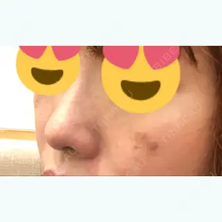 1日目の経過画像（2枚目）