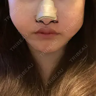 0日目の経過画像（3枚目）