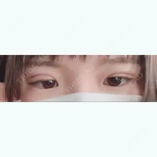 1日目の経過画像（1枚目）