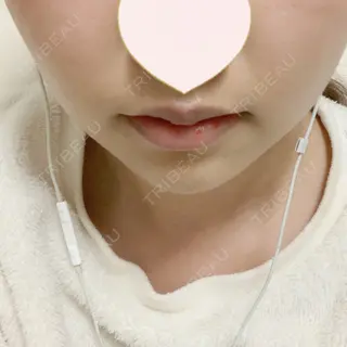 17日目の経過画像（1枚目）