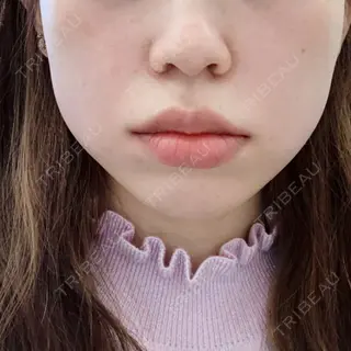 0日目の経過画像（2枚目）