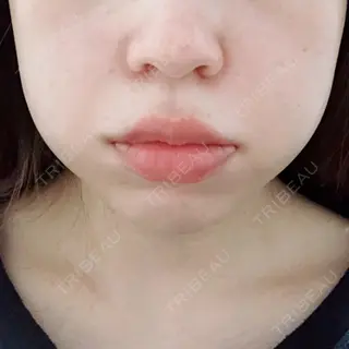 1日目の経過画像（1枚目）