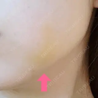 5日目の経過画像（2枚目）