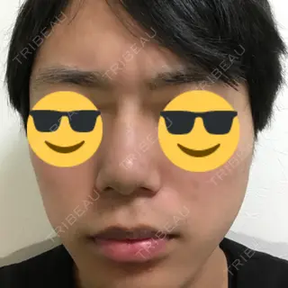 6日目の経過画像（1枚目）