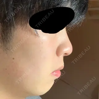 0日目の経過画像（2枚目）