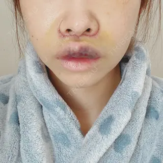 3日目の経過画像（1枚目）
