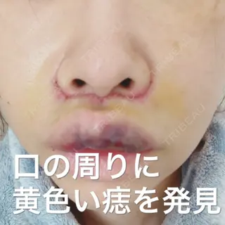 3日目の経過画像（3枚目）