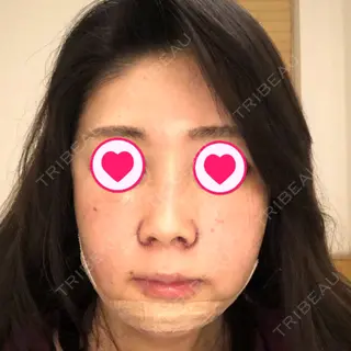 4日目の経過画像（1枚目）