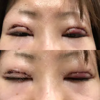1日目の経過画像（1枚目）
