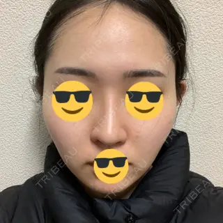 32日目の経過画像（2枚目）