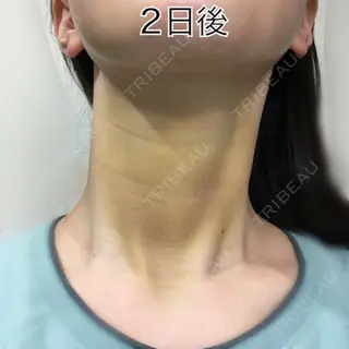 2日目の経過画像（1枚目）