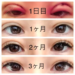92日目の経過画像（1枚目）