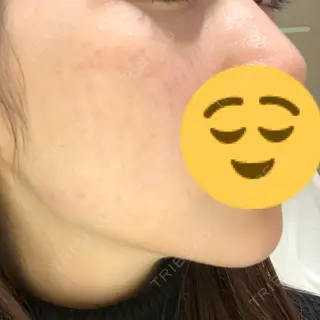 0日目の経過画像（2枚目）