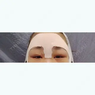 3日目の経過画像（1枚目）