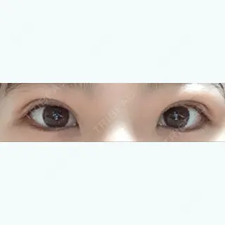 18日目の経過画像（1枚目）