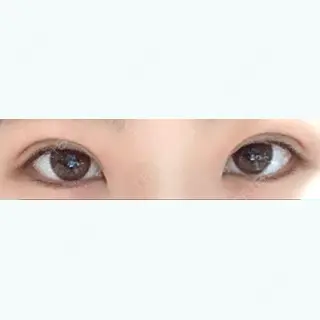20日目の経過画像（1枚目）